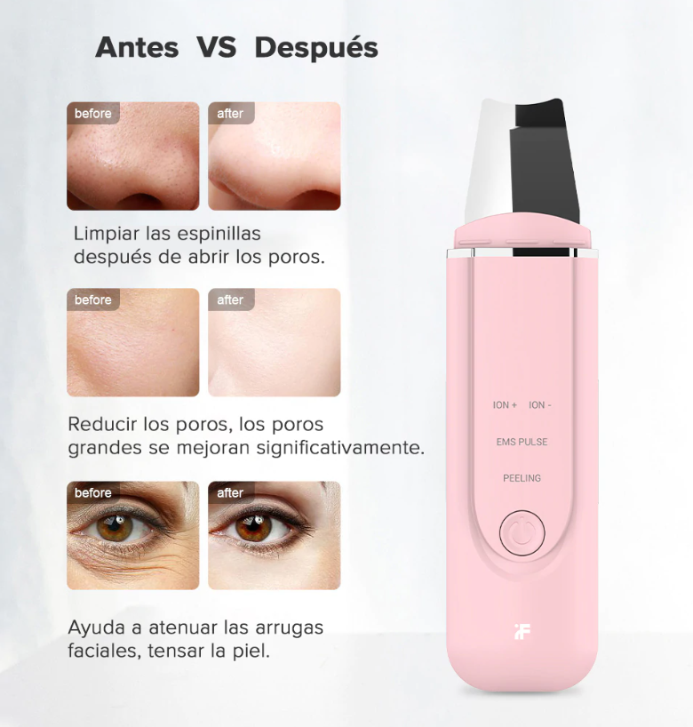 Máquina de iones ultrasónica limpieza de poros faciales de limpieza de espinillas