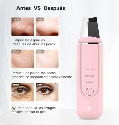 Máquina de iones ultrasónica limpieza de poros faciales de limpieza de espinillas